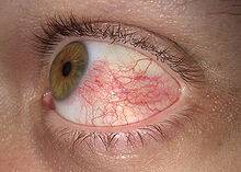 220px-Hyperemia_conjunctiva.jpg