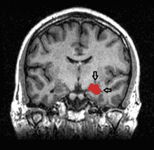 220px-MRI_Location_Hippocampus_up..png