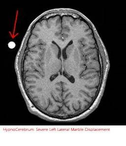 HypnocerebrumSevereleft.jpg