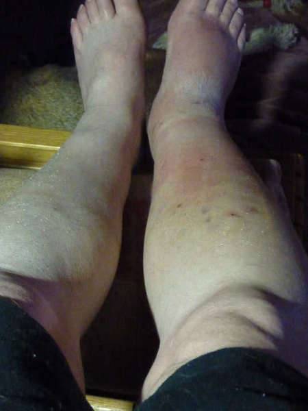 swelling.jpg