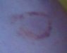 bruise 2a.jpg